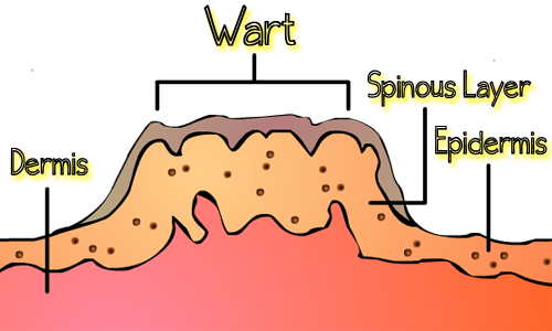 WartCrossSection11